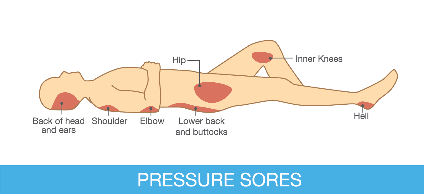 The Benefits of Pressure Redistributing Foam